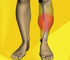 Перелом большой берцовой кости