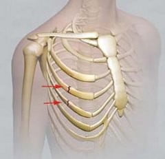 Перелом ребра