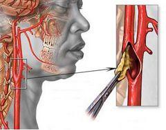 Операция на сонной артерии