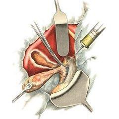 Удаление желчного протока