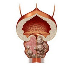Аденома простаты