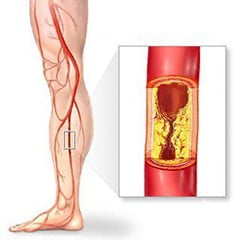 Лечение атеросклероза сосудов конечностей