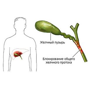 Дискинезия желчного пузыря