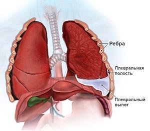 Экссудативный плеврит