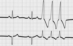Кардиограмма при экстрасистолии