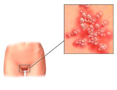 Генитальный герпес