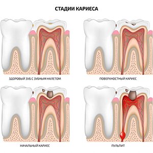 Кариес