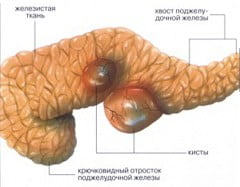 Киста поджелудочной железы