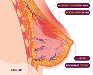 Мастит у кормящей матери