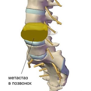 Метастазы в позвоночнике