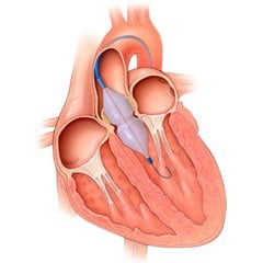 Лечение митрального стеноза
