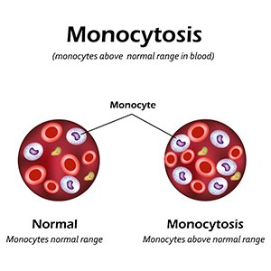 Моноцитоз