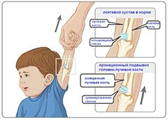 Подвывих головки лучевой кости