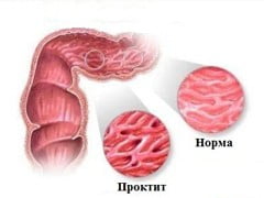 Проктит