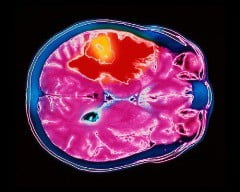 Поздняя стадия рака головного мозга
