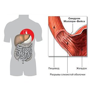 Синдром Мэллори-Вейса