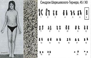 Синдром Шерешевского — Тернера