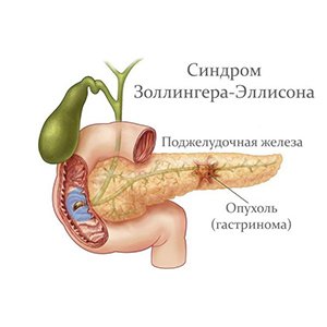 Синдром Золлингера — Эллисона