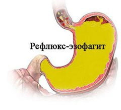 Поражение пищевода при системной склеродермии