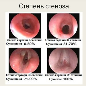 Степень стеноза гортани