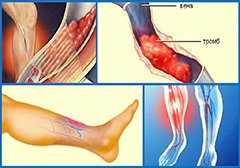 Тромбофлебит
