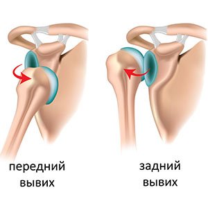 Вывих плечевого сустава